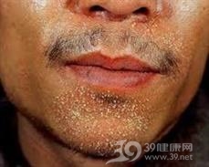 须疮