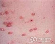 寻常狼疮