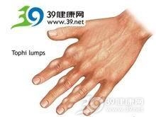 小儿播散性脂肪肉芽肿综合征