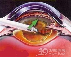 小儿单房性骨囊肿