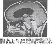 小儿颅后窝室管膜瘤