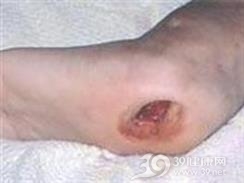 小儿慢性骨髓炎