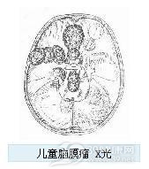 小儿脑膜瘤