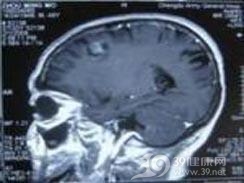 小儿视神经胶质瘤