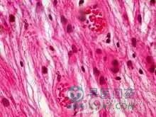 小儿星形细胞瘤