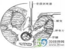 小儿硬脑膜外脓肿