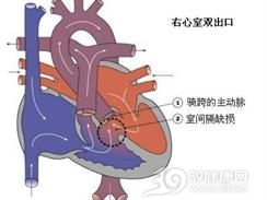 小儿右室双出口