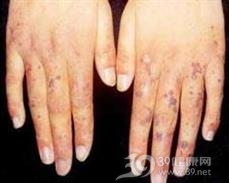 血管角化瘤