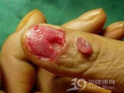 血管球瘤