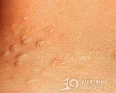血管脂肪瘤
