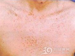 小汗腺汗管纤维腺瘤