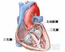 心肌梗塞并发二尖瓣关闭不全