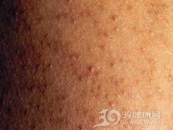 小棘毛壅病