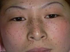 硒及其化合物引起的皮肤病