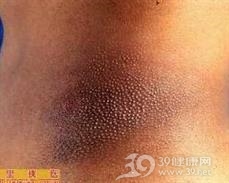 小棘苔藓