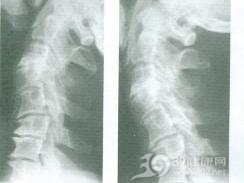 下颈椎不稳症