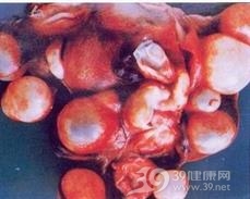 细粒棘球蚴病