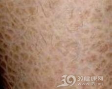 X联锁鱼鳞病