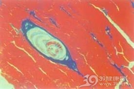 旋毛虫病