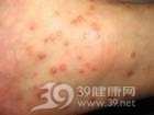 荨麻疹和血管性水肿