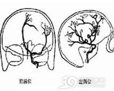 小脑脑桥角脑膜瘤