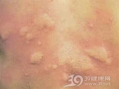 血清病性荨麻疹