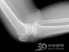血色病性骨关节病