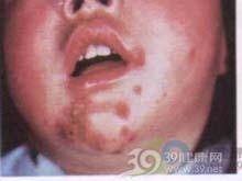 新生儿暂时性脓疱性黑变病