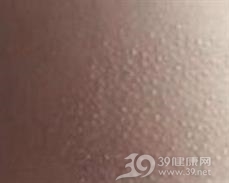 小提琴手颈部皮炎
