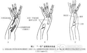先天性尺骨缺如