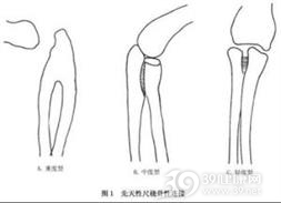 先天性尺桡骨性连接