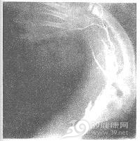 先天性腓骨缺如