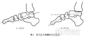 先天性高弓足