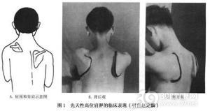 先天性高位肩胛