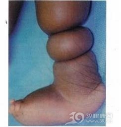 先天性环状束带
