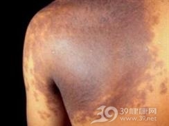 先天性巨大色素痣