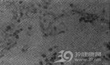 先天性巨细胞包涵体病