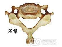 先天性颈椎齿状突畸形