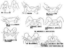 先天性髋关节外展挛缩和骨盆倾斜