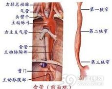 先天性食管狭窄