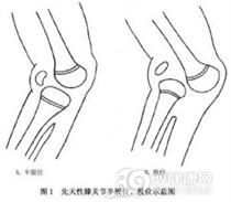 先天性膝关节脱位
