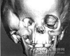 先天性小眼球合并眼眶囊肿
