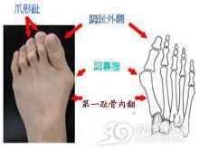 先天性仰趾外翻足