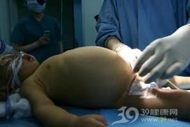 先天性肿瘤