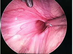 小网膜囊疝