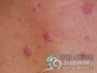 西瓦特皮肤异色病