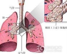 小细胞肺癌
