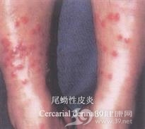 血吸虫尾蚴性皮炎