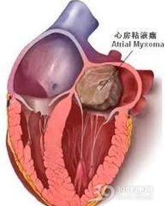 心脏横纹肌瘤
