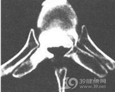 胸椎后纵韧带骨化症